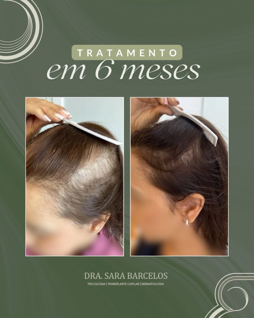 ✨ Resultado de 6 meses que começa com um diagnóstico correto.Essa paciente chegou até mim já fru