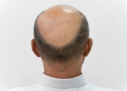 homem-corajoso-precisando-de-uma-extracao-de-unidade-folicular